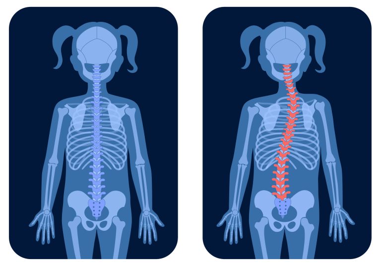 Scoliosis Awareness Day 2024 - Newcastle Hospitals NHS Foundation Trust