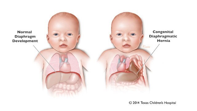 Diagram of two babies. One baby has title of Normal Diaphragm Development, and intact diaphragm labelled. The other baby has the title above it saying Congenital diaphragmatic hernia - label stating "defect in diaphragm allowing bowel and sometimes stomach and liver to herniate into the chest".