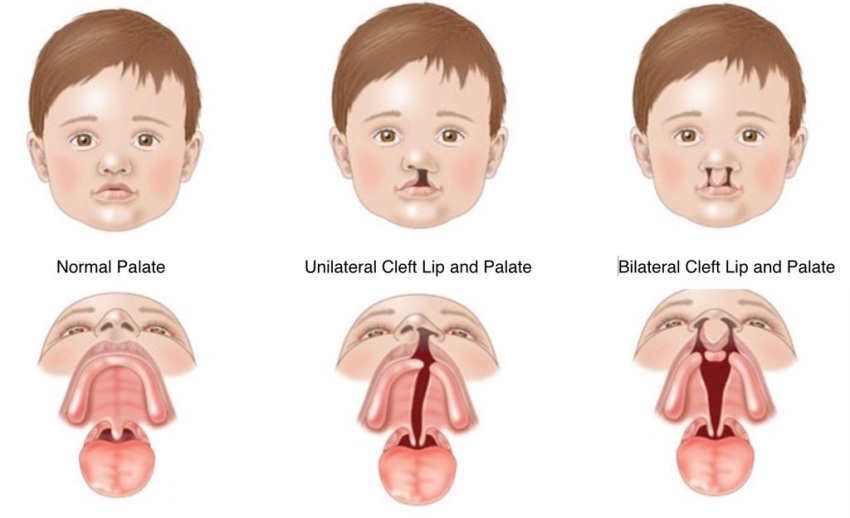 Diagram of child with different type of palate. 1 - Normal palate. 2 - Unilateral cleft lip and palate. 3 - Bilateral cleft lip and palate