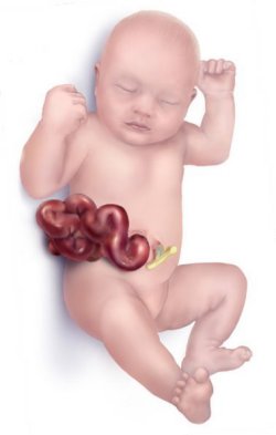 Diagram of baby with gastroschisis