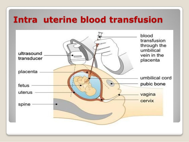 Diagram of intra uterine blood transfusion