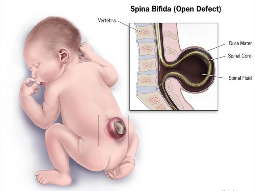 Diagram of baby with Spina Bifida (open defect). Vertebra, dura mater, spinal cord and spinal fluid all listed