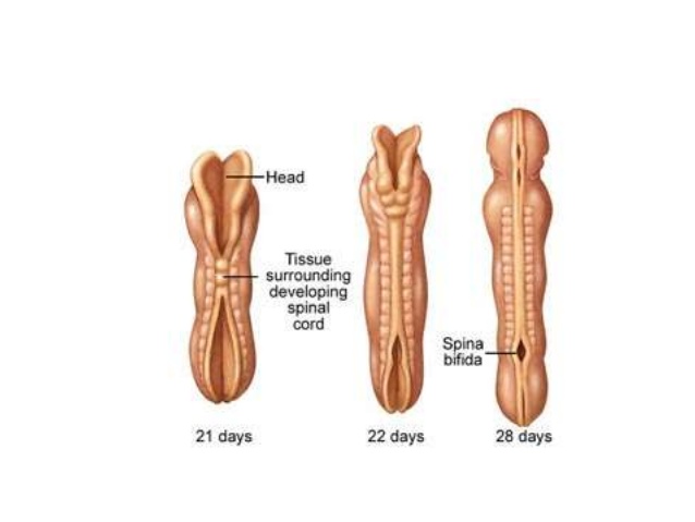 Spinal cord images. 21 days - with head and tissue surrounding developing spinal cord, 22 days. 28 days with spina bifida