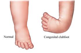 Diagram of baby feet. One normal and the other with congenital clubfoot